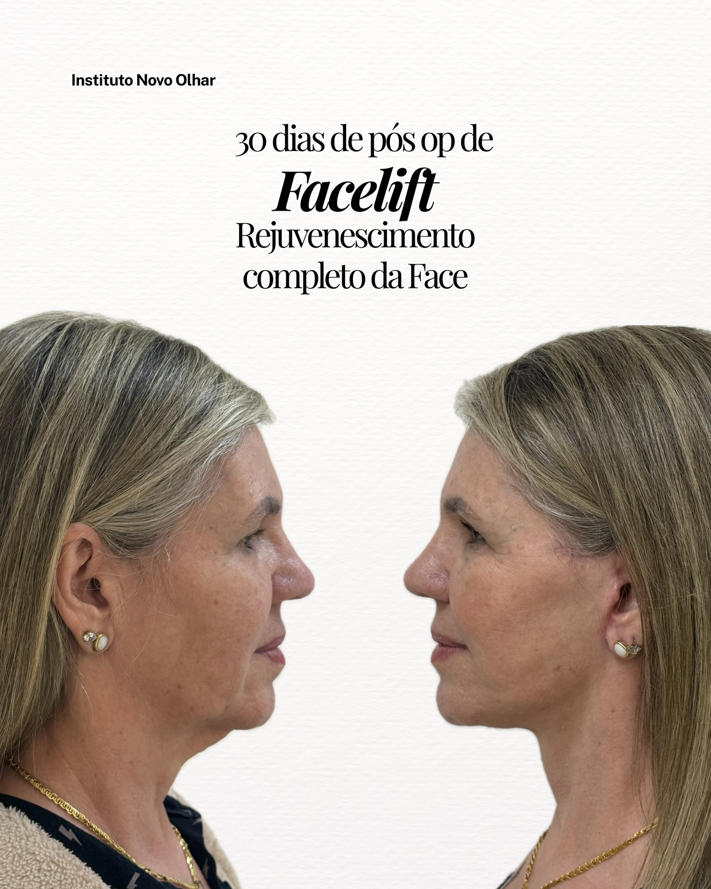 Resultado real — 30 dias de pós-operatório de facelift