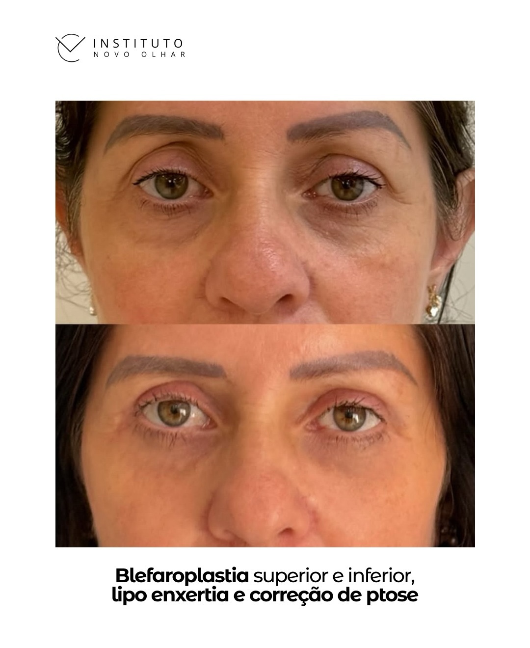 Resultado real — blefaroplastia superior e inferior com correção de ptose