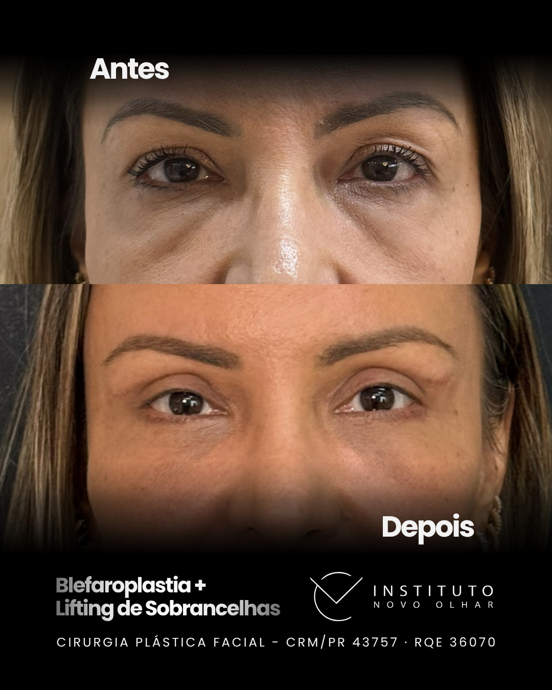 Resultado real — blefaroplastia com lifting de sobrancelhas