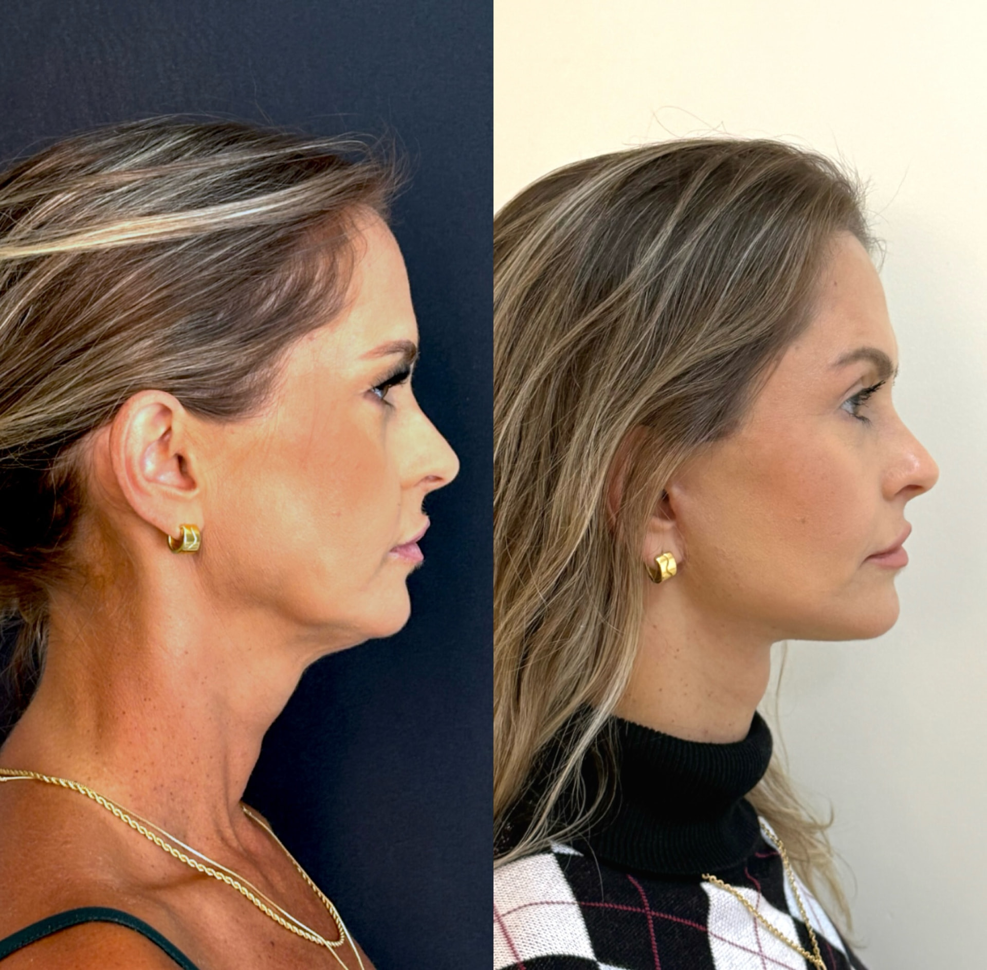 Resultado real — antes e depois de lifting facial em perfil