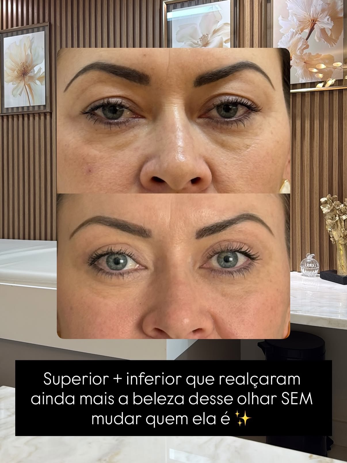 Resultado real — blefaroplastia superior e inferior